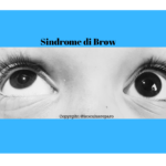 sindrome di brown, occhio destro si eleva mentre occhio sinistro rimane fisso