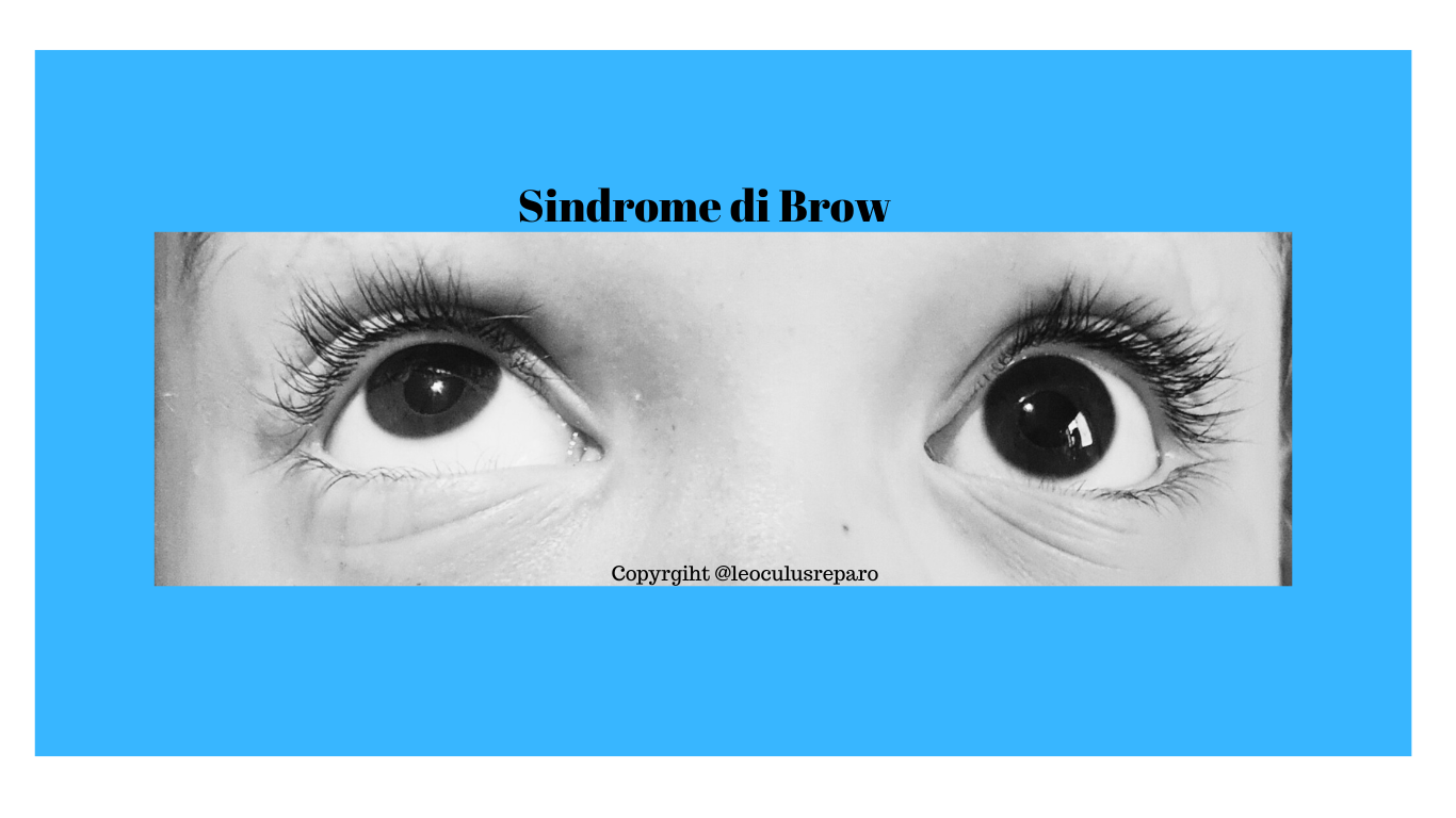 sindrome di brown, occhio destro si eleva mentre occhio sinistro rimane fisso